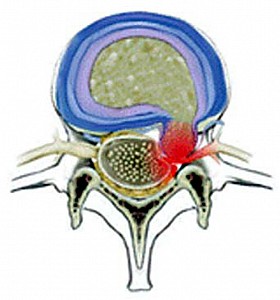 Herniation of intervertebral disc ( herniation of vertebral pulp)