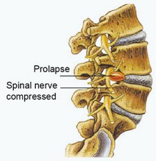 What is a Decompression Therapy?